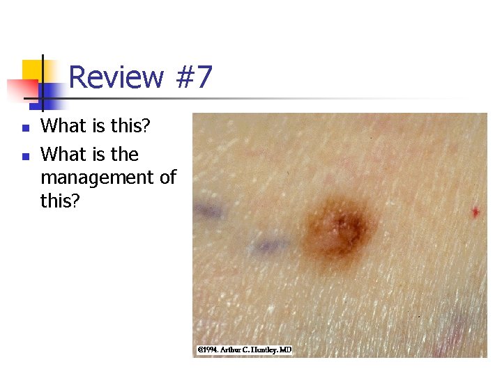 Review #7 n n What is this? What is the management of this? 