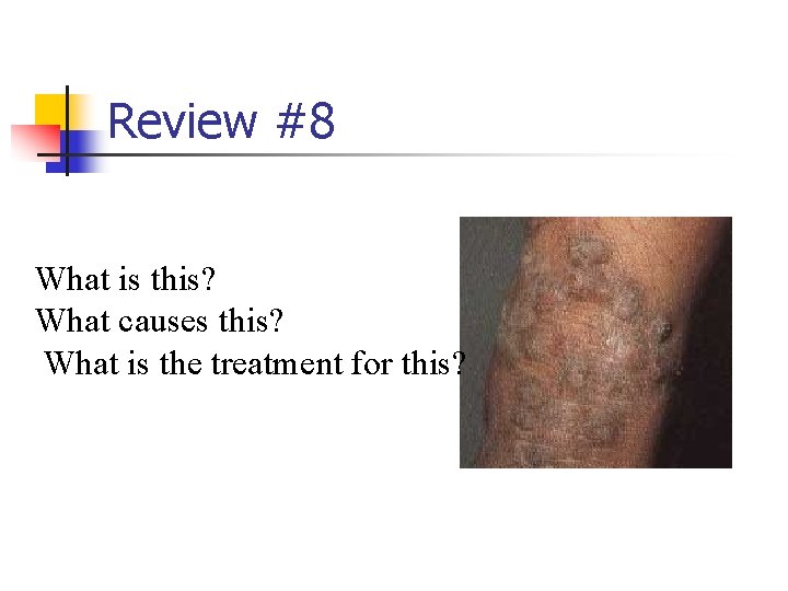 Review #8 What is this? What causes this? What is the treatment for this?