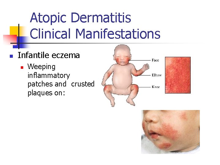 Atopic Dermatitis Clinical Manifestations n Infantile eczema n Weeping inflammatory patches and crusted plaques