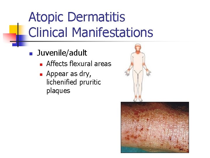 Atopic Dermatitis Clinical Manifestations n Juvenile/adult n n Affects flexural areas Appear as dry,