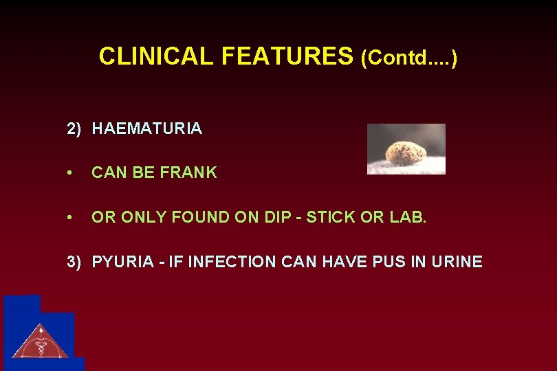 CLINICAL FEATURES (Contd. . ) 2) HAEMATURIA • CAN BE FRANK • OR ONLY