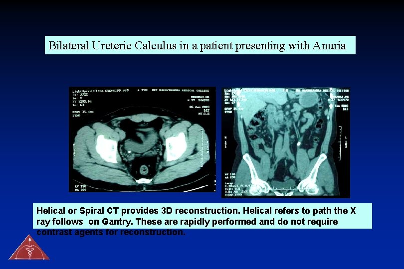 Bilateral Ureteric Calculus in a patient presenting with Anuria Helical or Spiral CT provides