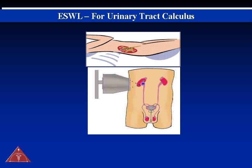 ESWL – For Urinary Tract Calculus 