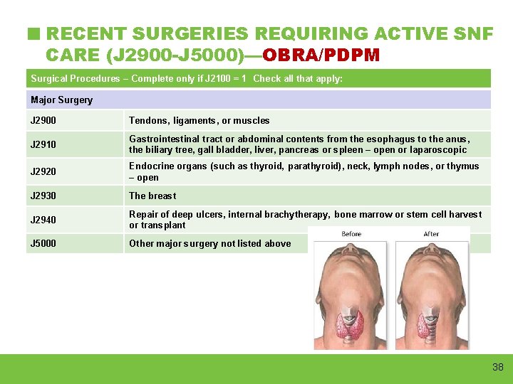 RECENT SURGERIES REQUIRING ACTIVE SNF CARE (J 2900 -J 5000)—OBRA/PDPM Surgical Procedures – Complete