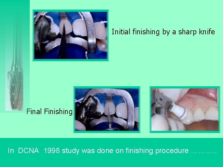 Initial finishing by a sharp knife Final Finishing In DCNA 1998 study was done