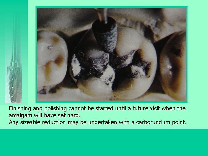 Finishing and polishing cannot be started until a future visit when the amalgam will