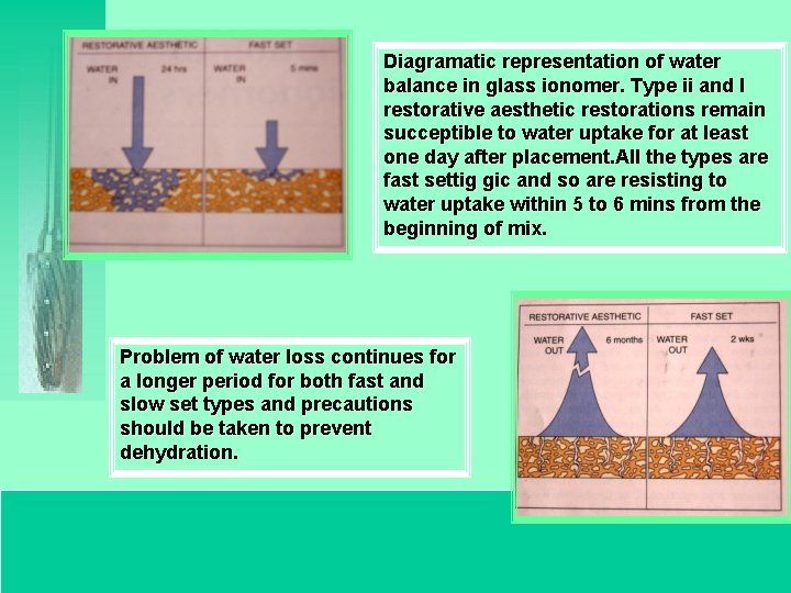 Diagramatic representation of water balance in glass ionomer. Type ii and I restorative aesthetic