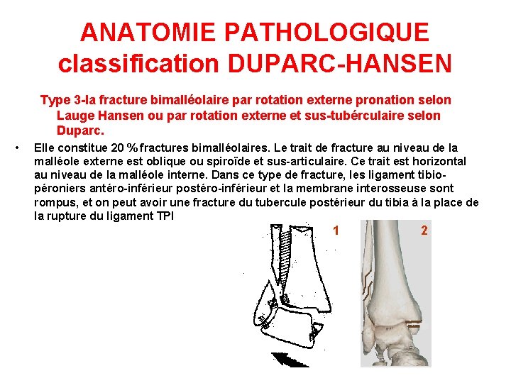 ANATOMIE PATHOLOGIQUE classification DUPARC-HANSEN Type 3 -la fracture bimalléolaire par rotation externe pronation selon