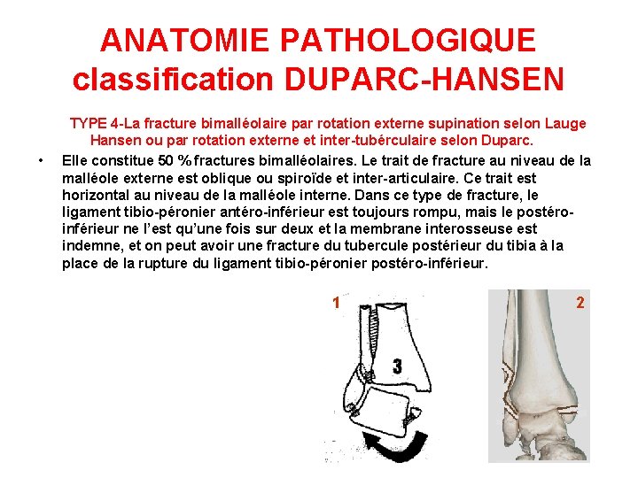 ANATOMIE PATHOLOGIQUE classification DUPARC-HANSEN • TYPE 4 -La fracture bimalléolaire par rotation externe supination