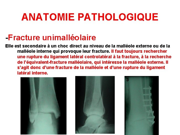 ANATOMIE PATHOLOGIQUE -Fracture unimalléolaire Elle est secondaire à un choc direct au niveau de