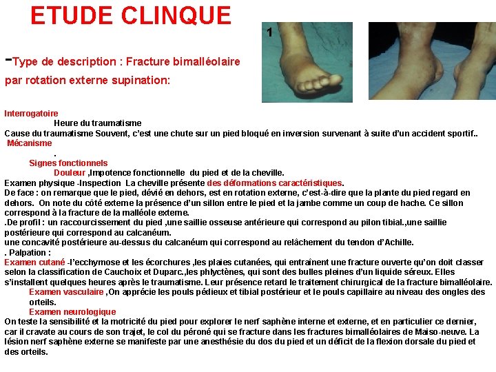 ETUDE CLINQUE 1 2 -Type de description : Fracture bimalléolaire par rotation externe supination: