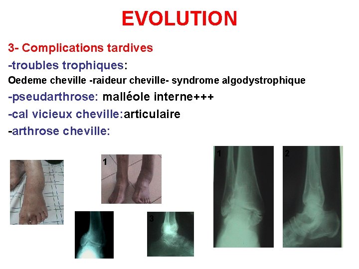 EVOLUTION 3 - Complications tardives -troubles trophiques: Oedeme cheville -raideur cheville- syndrome algodystrophique -pseudarthrose: