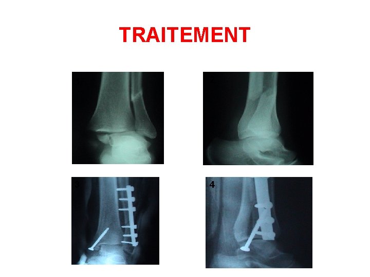 TRAITEMENT 1 2 3 4 