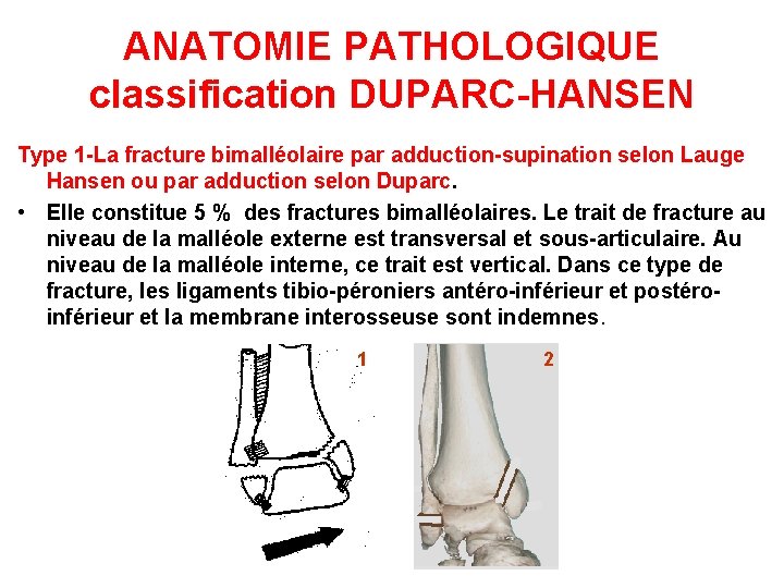 ANATOMIE PATHOLOGIQUE classification DUPARC-HANSEN Type 1 -La fracture bimalléolaire par adduction-supination selon Lauge Hansen