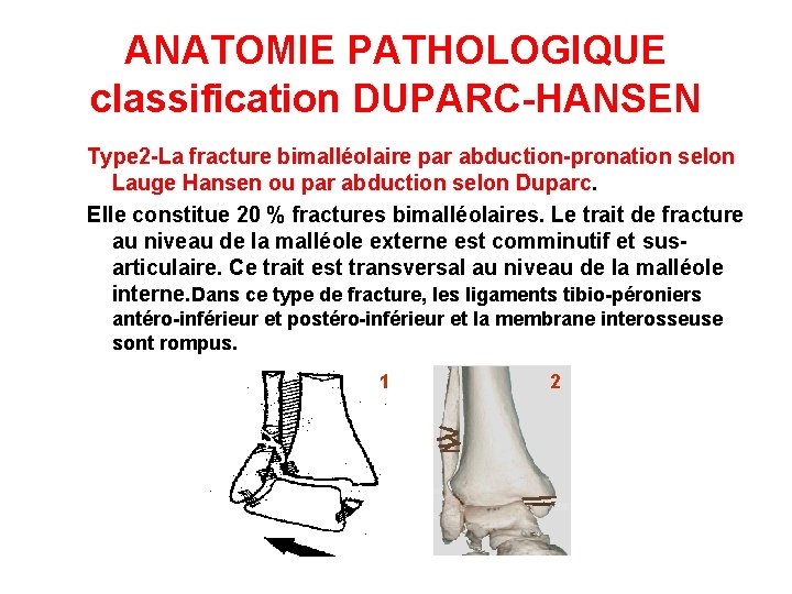ANATOMIE PATHOLOGIQUE classification DUPARC-HANSEN Type 2 -La fracture bimalléolaire par abduction-pronation selon Lauge Hansen