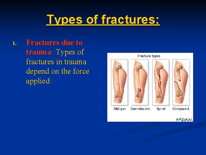 Types of fractures: 1. Fractures due to trauma: Types of fractures in trauma depend