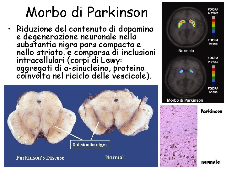 Morbo di Parkinson • Riduzione del contenuto di dopamina e degenerazione neuronale nella substantia