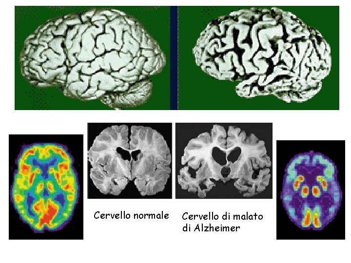 PET scan Cervello normale Cervello di malato di Alzheimer 