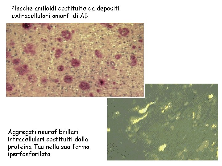 Placche amiloidi costituite da depositi extracellulari amorfi di A Aggregati neurofibrillari intracellulari costituiti dalla