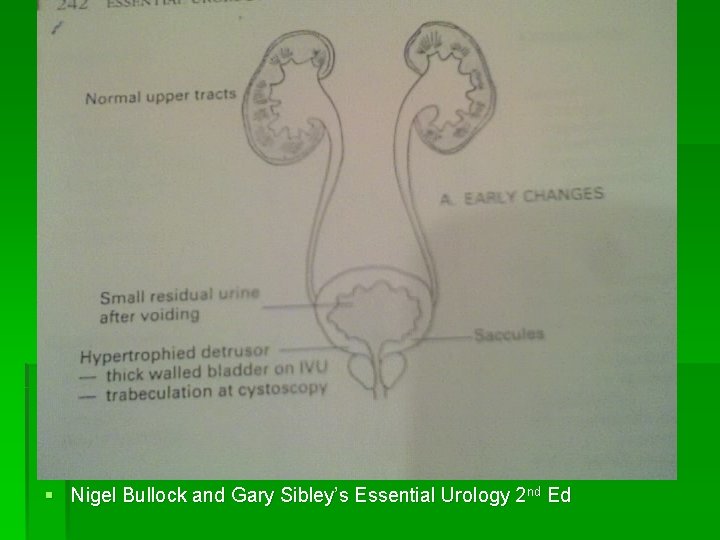Early changes § Nigel Bullock and Gary Sibley’s Essential Urology 2 nd Ed 