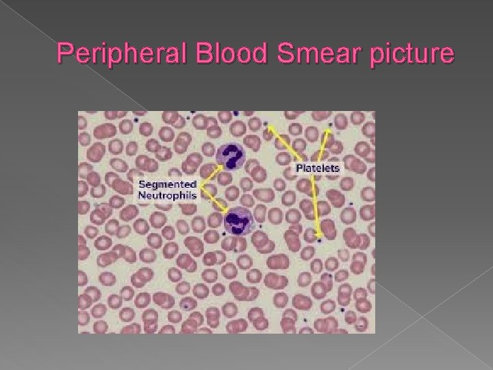 Peripheral Blood Smear picture 