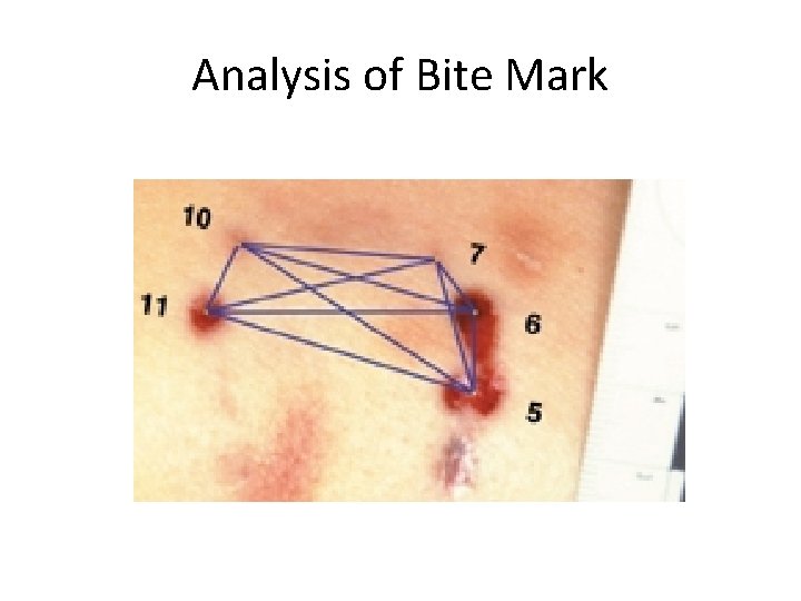 Analysis of Bite Mark 