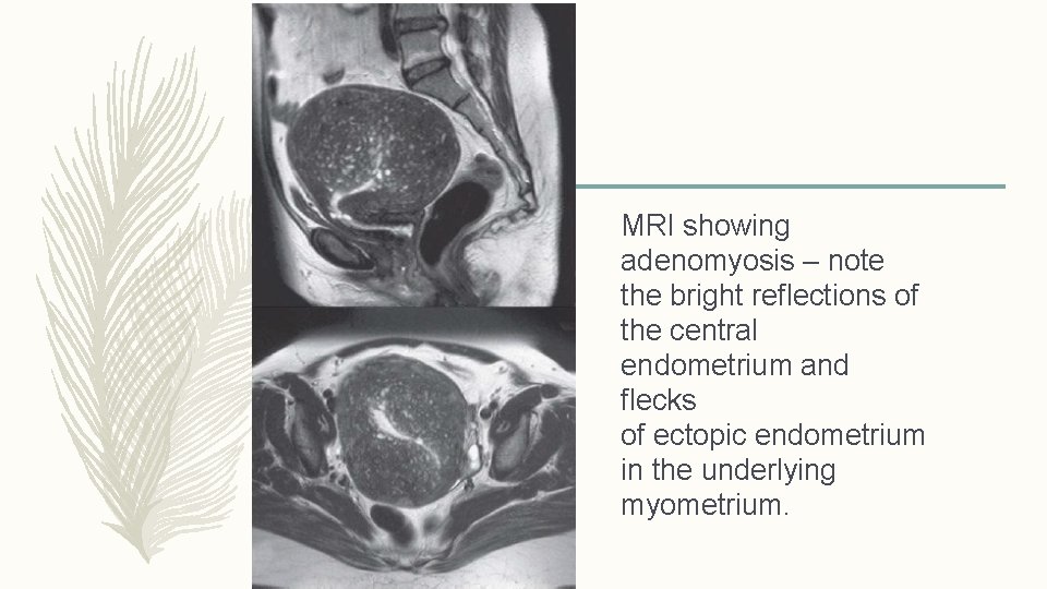 MRI showing adenomyosis – note the bright reflections of the central endometrium and flecks