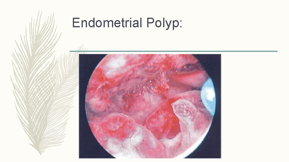 Endometrial Polyp: 