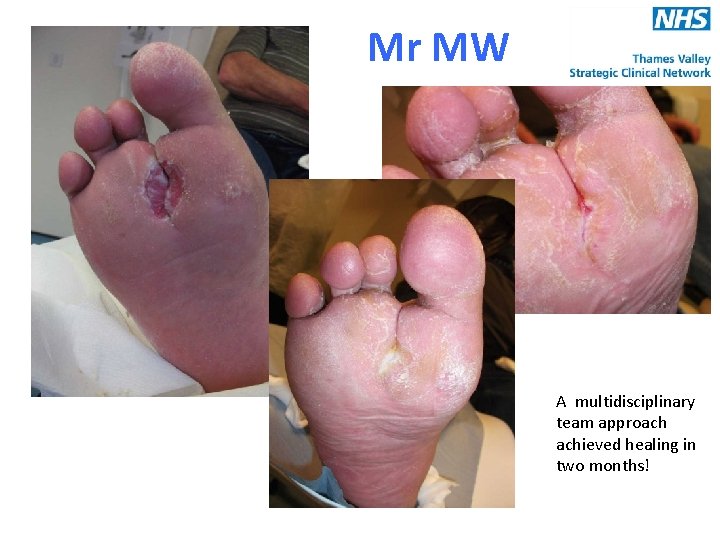 Mr MW A multidisciplinary team approach achieved healing in two months! 