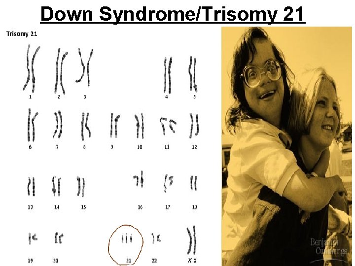 Down Syndrome/Trisomy 21 