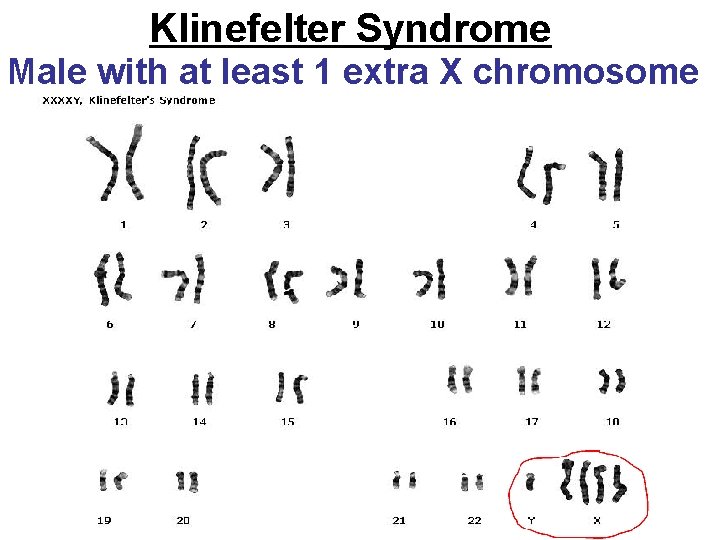 Klinefelter Syndrome Male with at least 1 extra X chromosome 