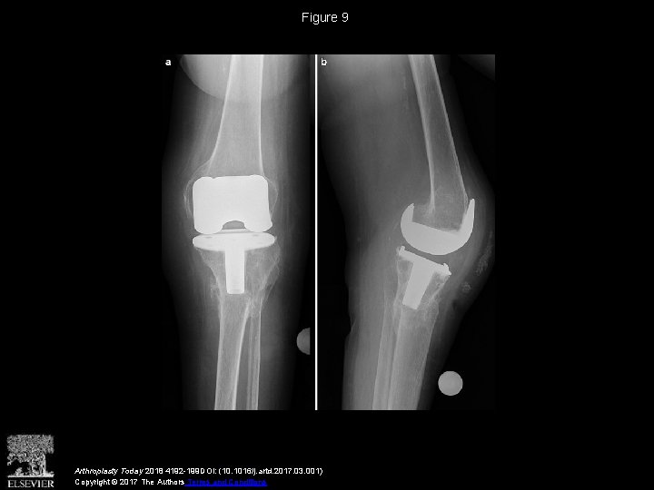 Figure 9 Arthroplasty Today 2018 4192 -199 DOI: (10. 1016/j. artd. 2017. 03. 001)