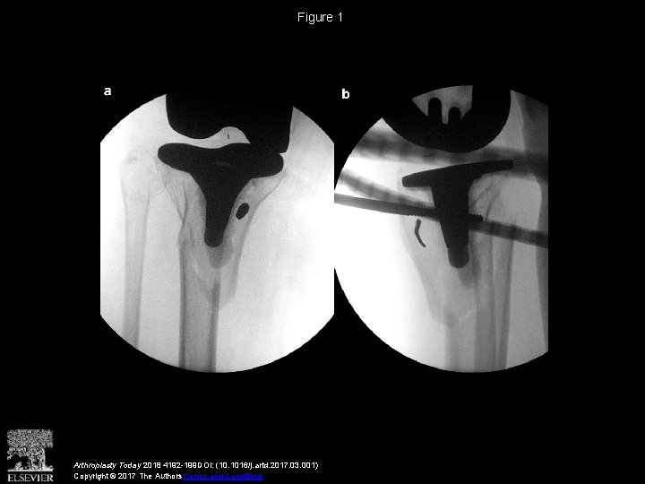 Figure 1 Arthroplasty Today 2018 4192 -199 DOI: (10. 1016/j. artd. 2017. 03. 001)
