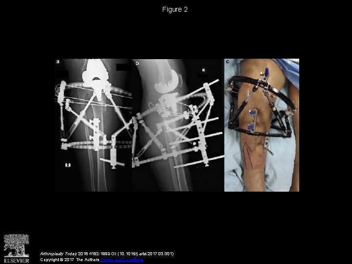 Figure 2 Arthroplasty Today 2018 4192 -199 DOI: (10. 1016/j. artd. 2017. 03. 001)