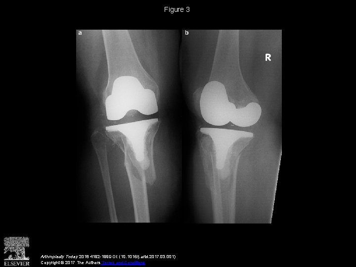 Figure 3 Arthroplasty Today 2018 4192 -199 DOI: (10. 1016/j. artd. 2017. 03. 001)