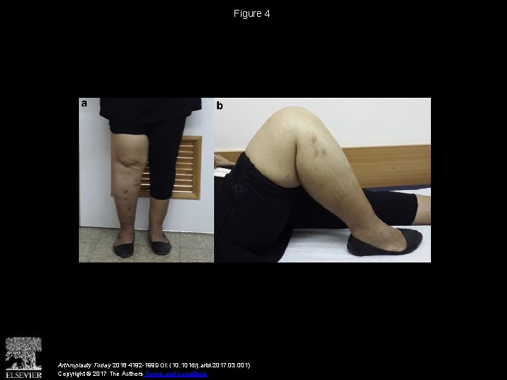 Figure 4 Arthroplasty Today 2018 4192 -199 DOI: (10. 1016/j. artd. 2017. 03. 001)