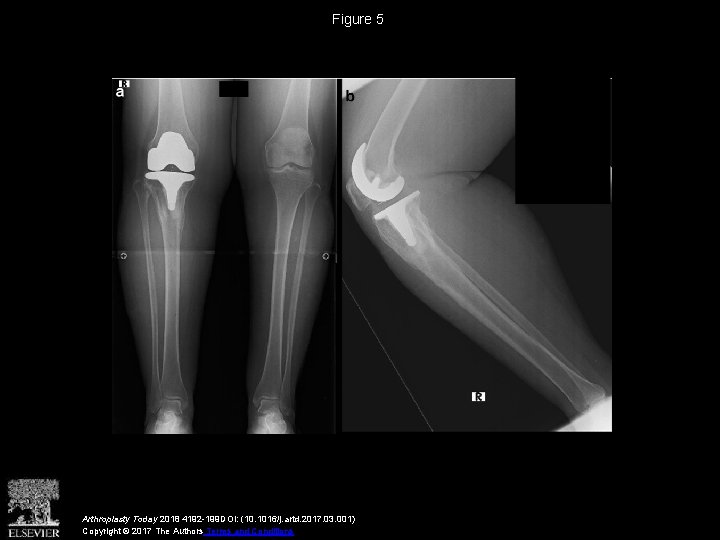 Figure 5 Arthroplasty Today 2018 4192 -199 DOI: (10. 1016/j. artd. 2017. 03. 001)