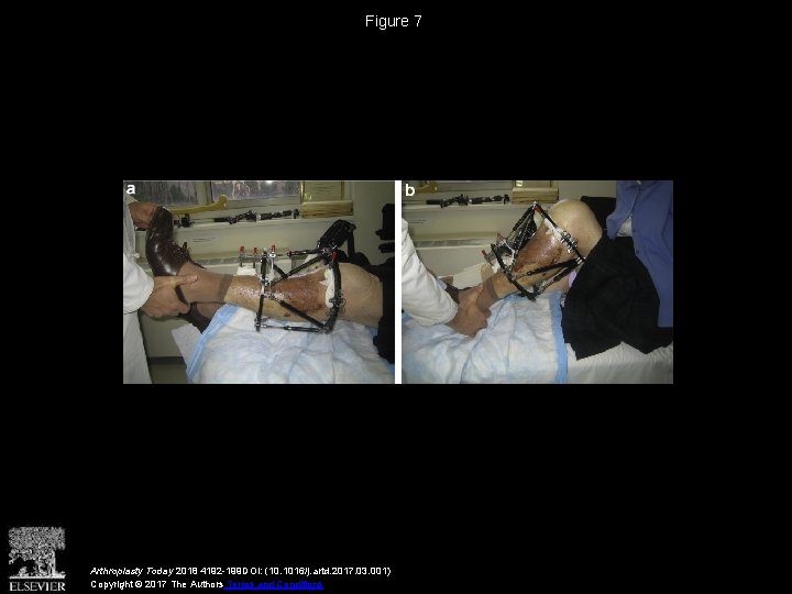 Figure 7 Arthroplasty Today 2018 4192 -199 DOI: (10. 1016/j. artd. 2017. 03. 001)
