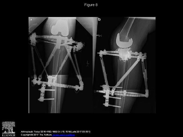Figure 8 Arthroplasty Today 2018 4192 -199 DOI: (10. 1016/j. artd. 2017. 03. 001)