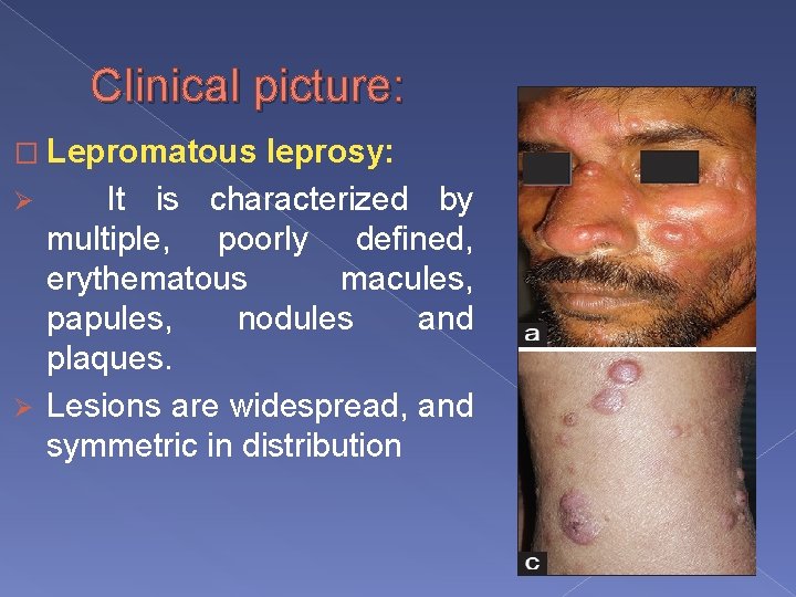 Clinical picture: � Lepromatous leprosy: Ø It is characterized by multiple, poorly defined, erythematous