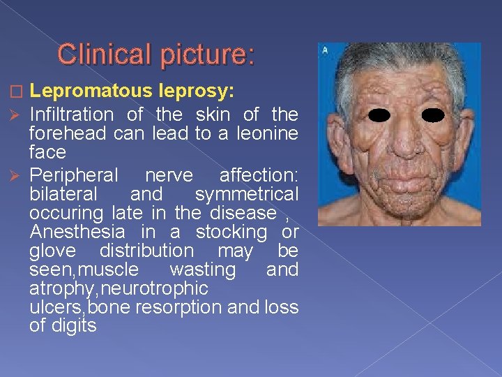 Clinical picture: Lepromatous leprosy: Infiltration of the skin of the forehead can lead to