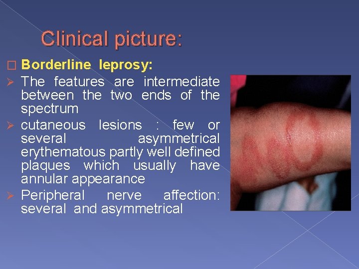 Clinical picture: Borderline leprosy: The features are intermediate between the two ends of the