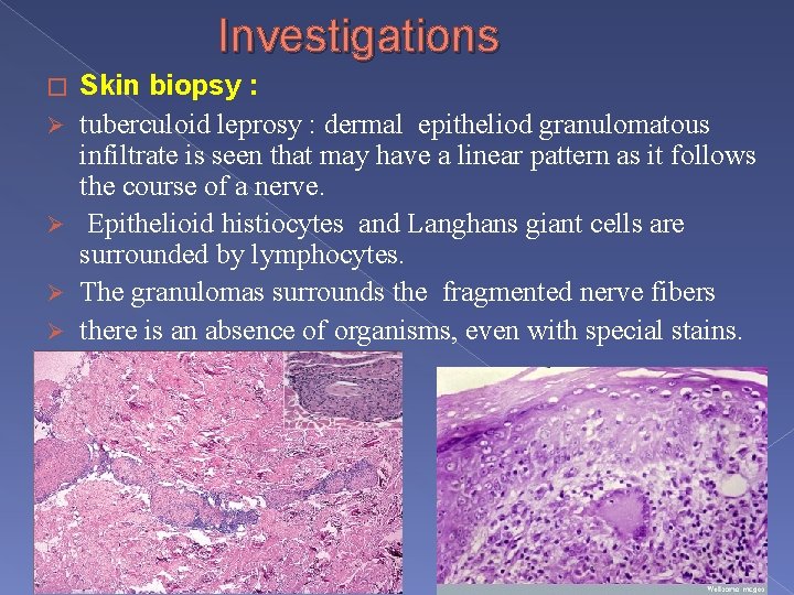 Investigations � Ø Ø Skin biopsy : tuberculoid leprosy : dermal epitheliod granulomatous infiltrate