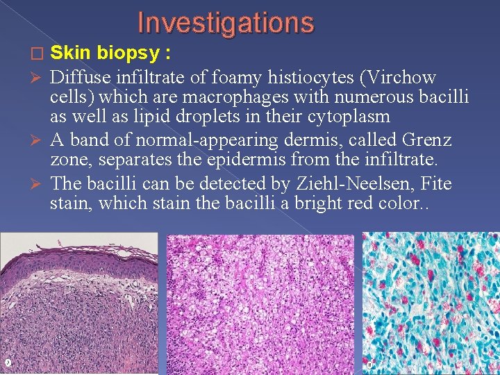 Investigations Skin biopsy : Ø Diffuse infiltrate of foamy histiocytes (Virchow cells) which are