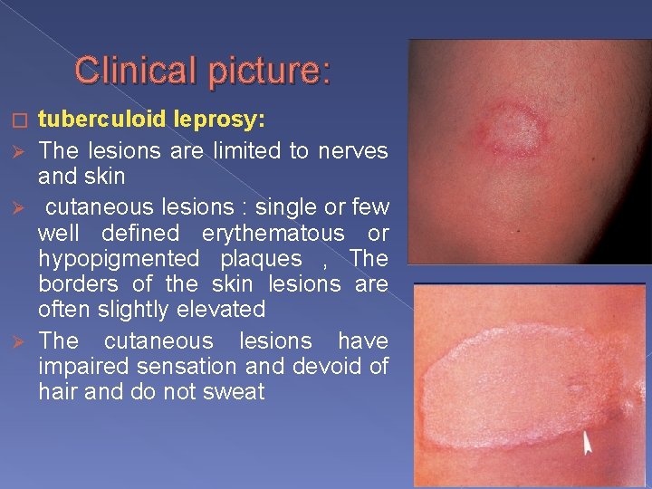 Clinical picture: tuberculoid leprosy: Ø The lesions are limited to nerves and skin Ø