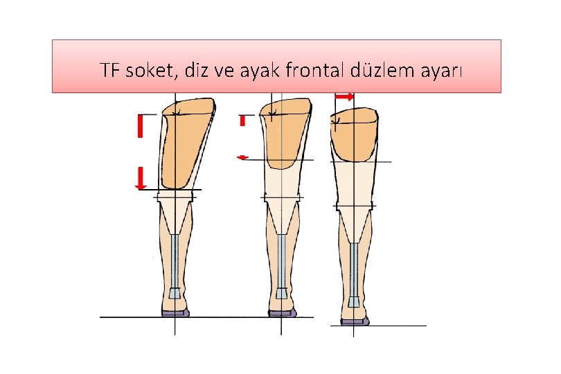 TF soket, diz ve ayak frontal düzlem ayarı 