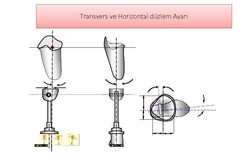 Transvers ve Horizontal düzlem Ayarı TF protez bağlantı parçaları ve ayarları, Serap Alsancak, 11