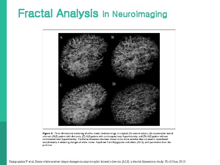 Fractal Analysis in Neuroimaging Rajagopalan V et al, Brain white matter shape changes in