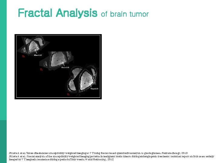 Fractal Analysis of brain tumor Di Ieva A et al, Three-dimensional susceptibility-weighted imaging at