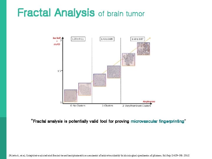 Fractal Analysis of brain tumor “Fractal analysis is potentially valid tool for proving microvascular